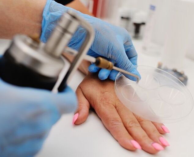 Criodestrucción un método para eliminar las verrugas en las manos mediante congelación con nitrógeno líquido. 